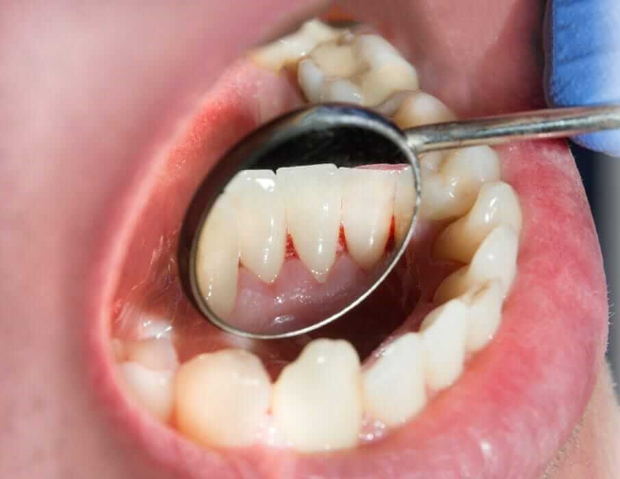 After Gum Treatment