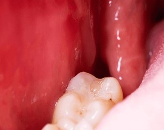 After Wisdom Tooth Removal