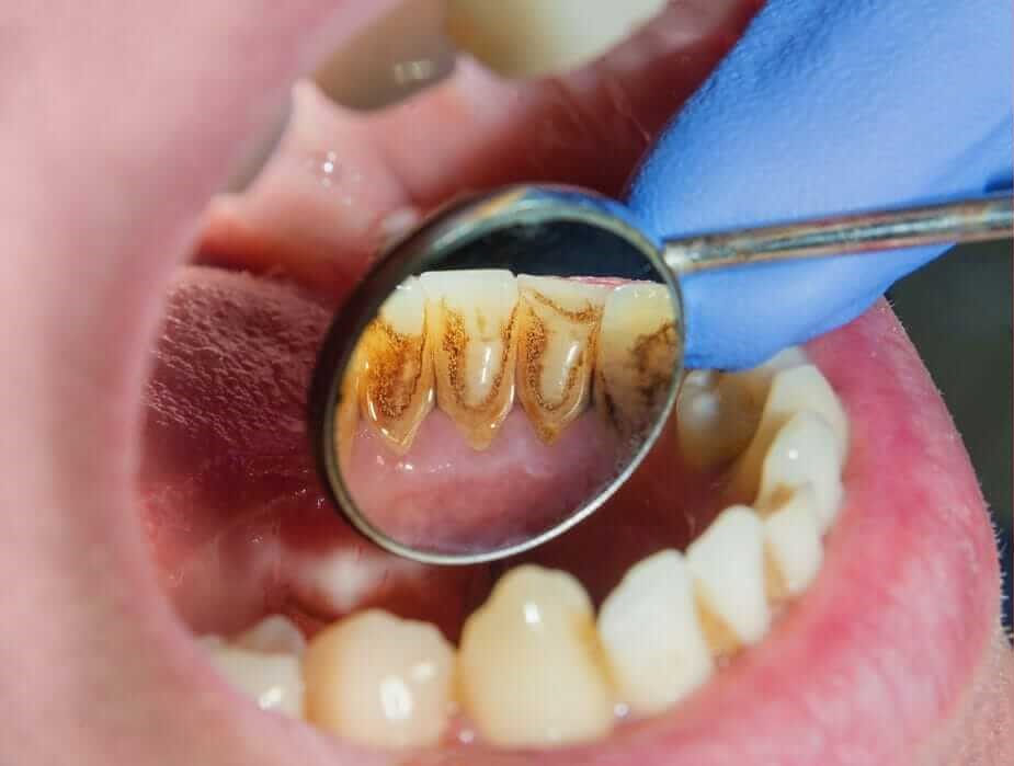 Before Gum Treatment