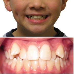 Before Kids Dentistry