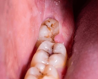 Before Wisdom Tooth Removal