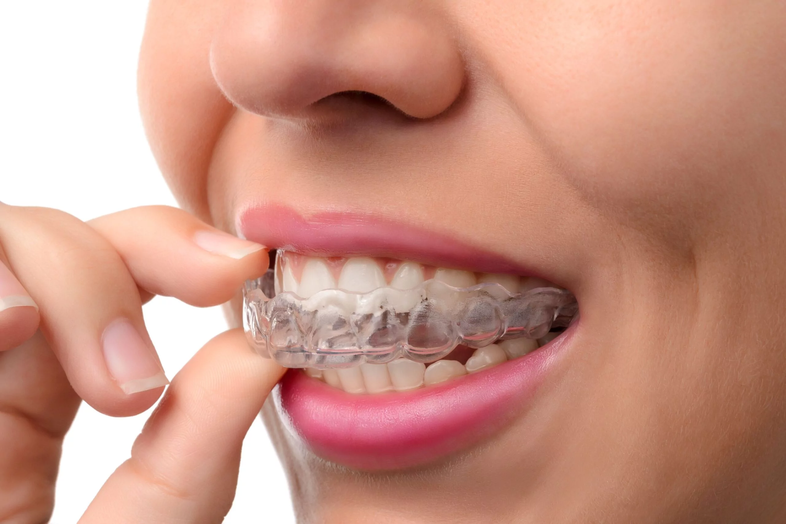 Invisalign aligners treatment