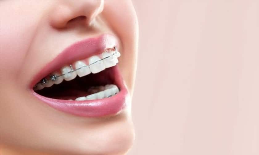 Dental braces