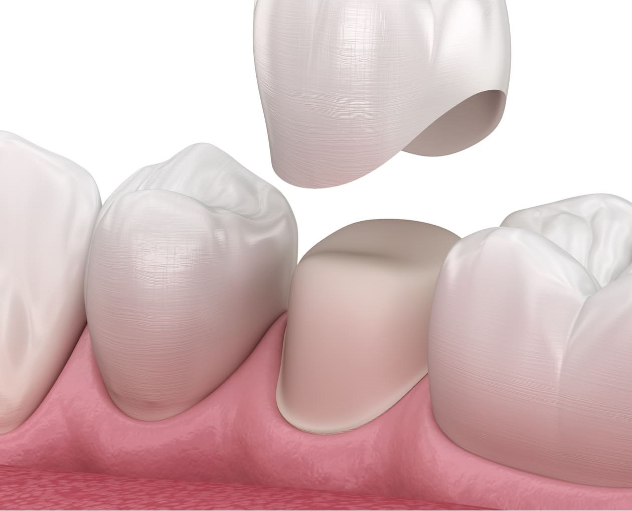 Dental veneers services