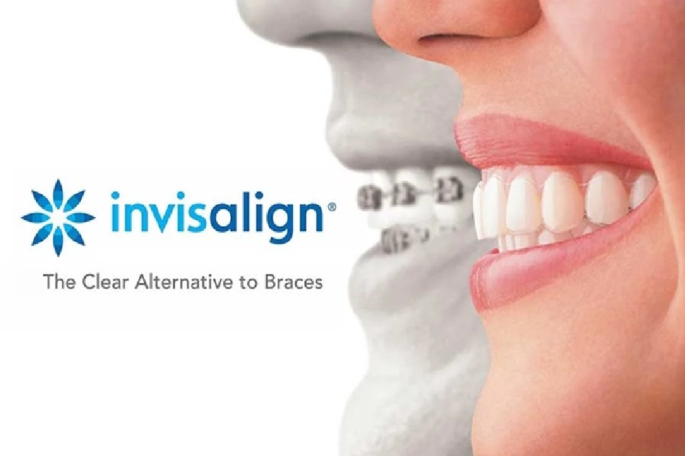 USA Invisalign Technology