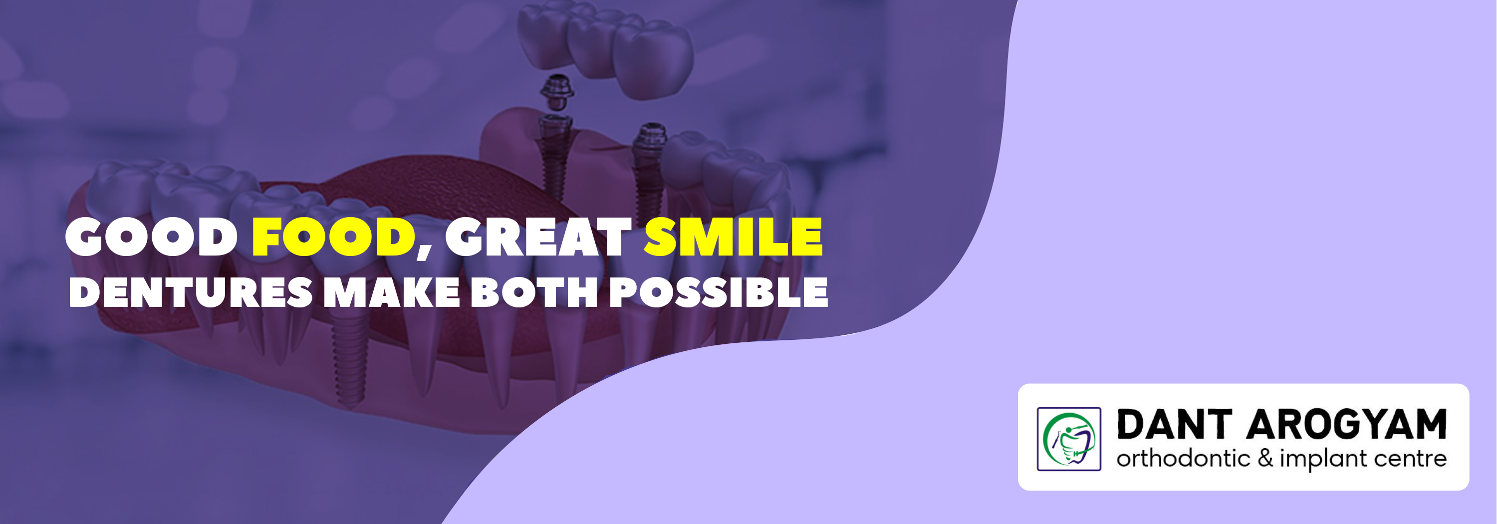 Clove Dental Summer Offers - Teeth Braces